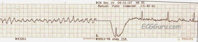 Defibrillation Ecg Guru Instructor Resources